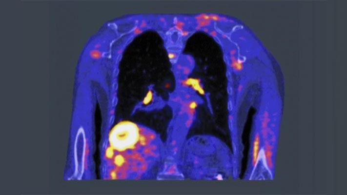 PET scan highlights cancer cells using a small amount of a radioactive drug, called a tracer