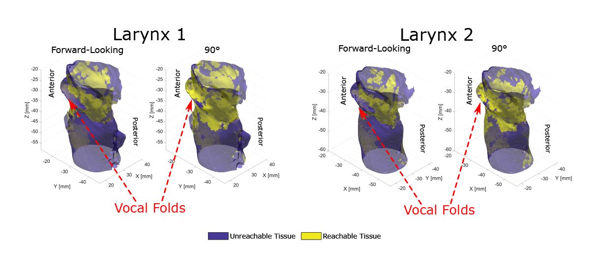 Simulaciones de laringe que comparan las áreas alcanzables por las fibras orientadas hacia adelante versus las fibras de 90° y demuestran que la fibra de 90° alcanza más áreas.