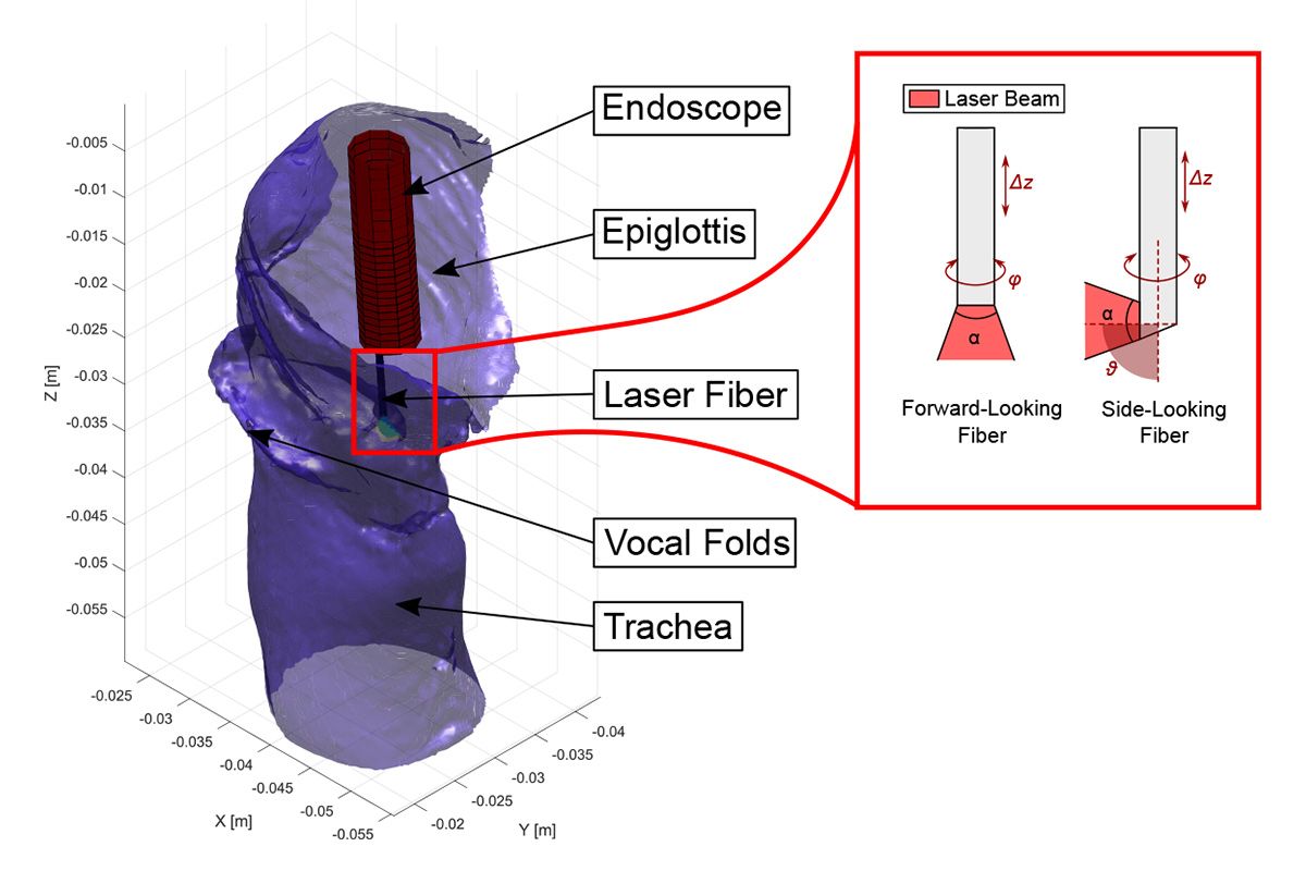 Una simulación de laringe que muestra el endoscopio insertado, la epiglotis, las cuerdas vocales y la tráquea. El modelo láser de la derecha muestra que la fibra orientada a los lados tiene hasta 90 grados de movimiento en comparación con la fibra orientada hacia adelante.