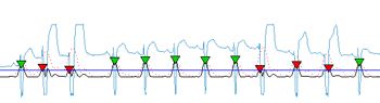 Figure 1.  A saturated signal showing distortion with its values clipped. The proposed algorithm can detect QRS even in signals like these.