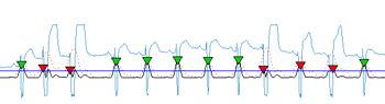 Figure 1. A saturated signal showing distortion with its values clipped. The proposed algorithm can detect QRS even in signals like these.