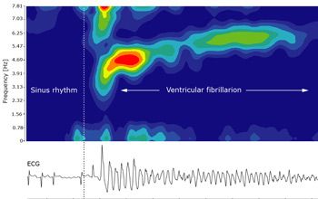 Figure 4. Time-frequency analysis of ventricular fibrillation. Frequency peaks in the range of 3-6Hz indicate fibrillation or flutter.