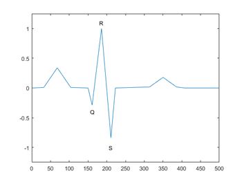 Figure 2. A QRS complex from an ECG signal.