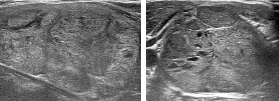 Ultrasonography images of a benign nodule and a malignant nodule.