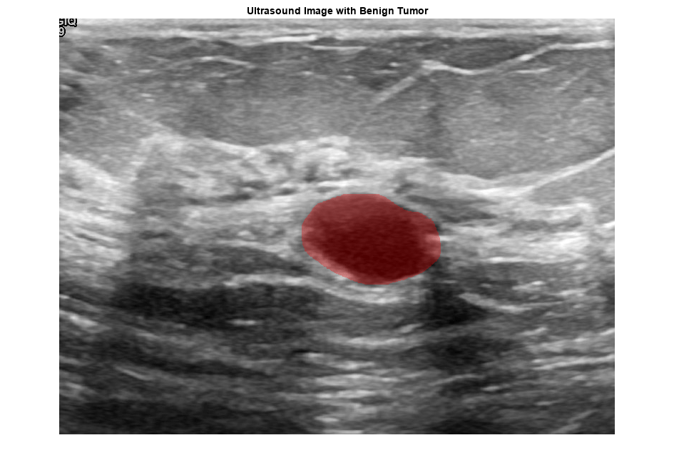 Figure contains an axes object. The axes object with title Ultrasound Image with Benign Tumor contains an object of type image.