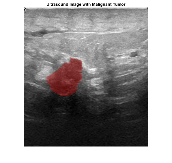 Figure contains an axes object. The axes object with title Ultrasound Image with Malignant Tumor contains an object of type image.