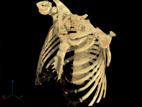 Volume display after removing the CT bed using 3-D scissors