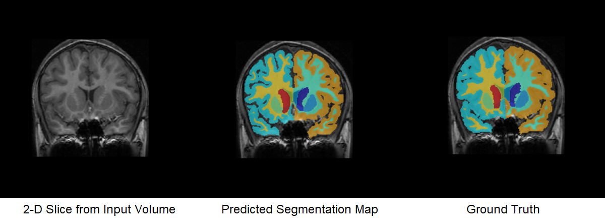 Brain MRI Segmentation Using Pretrained 3-D U-Net Network
