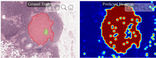Classify Tumors in Multiresolution Blocked Images