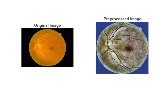 Multilabel Diabetic Retinopathy Fundus Image Classification Using Deep Learning