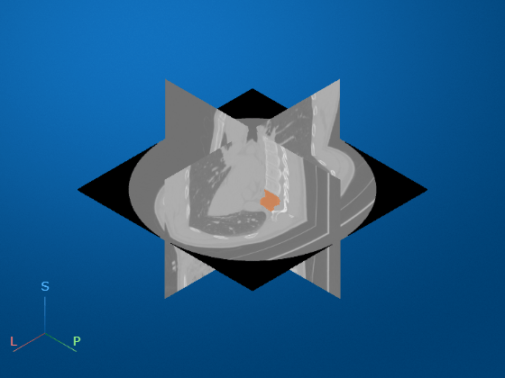 Analyze Vertebral Bone Density in Segmented CT Scan