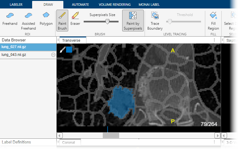 Lung tumor label drawn using the paint by superpixels tool