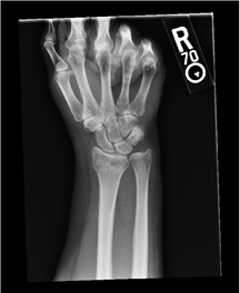 Forearm X-ray