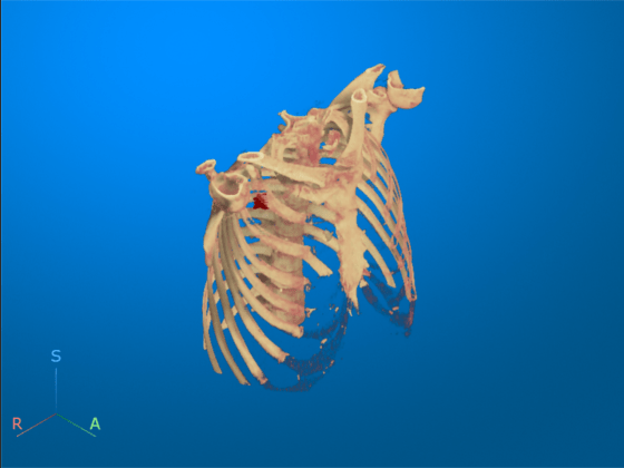 Chest CT with tumor label displayed using the volshow function